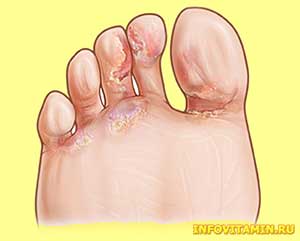 Эпидермофития ног — симптомы, причины, лечение витаминами, травами и добавками